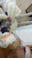 The Real Process Of The Doctor Removing Liquid From Covid-19 Patient