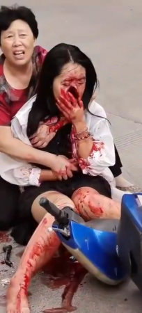 Teen Girl Face Destroyed In Accident