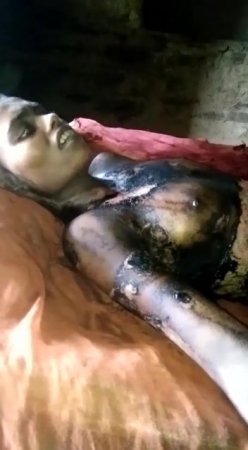 Burned Girl In Pain