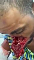 A Video Of A Man Whose Face Was Cut By A Machete