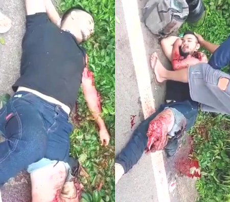 A Motorcyclist's Leg Was Torn Off Above The Knee As A Result Of A Road Accident