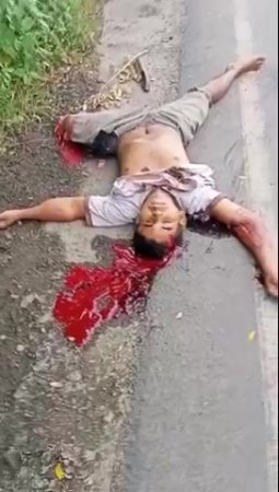 Dead Motorcyclist With A Severed Leg In An Accident
