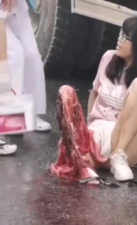 As A Result Of An Accident, All The Meat Of A Woman's Legs Was Stripped