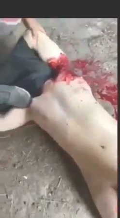 A Man's Arms And Legs Are Cut Off Alive