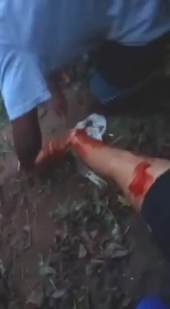 Woman's Feet Cut Off Alive