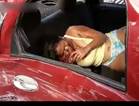 As A Result Of An Accident, The Skin On The Face Of The Woman Was Torn Off And The Eyeball Fell Out. The Perpetrator Of The Incident May Be Killed