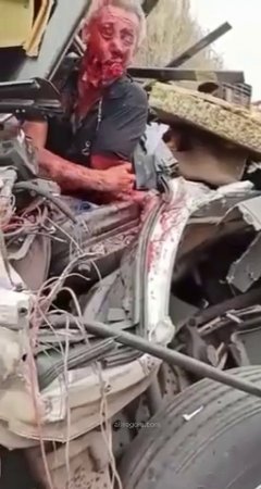 Truck Driver With A Disfigured Face. Aftermath