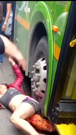 A Bus Ran Over One Leg Of A Woman. Bogota, Columbia
