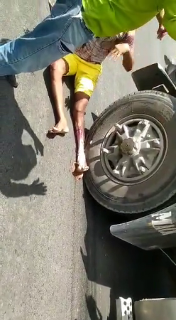The Skin On The Man's Leg Was Torn Off By A Truck Wheel