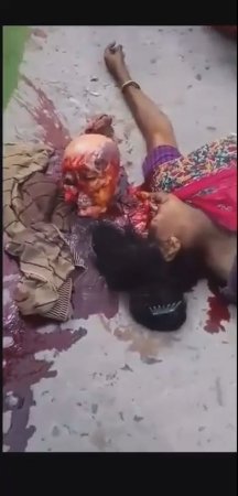 Woman's Skull Popped Out Of Her Skin In An Accident. India