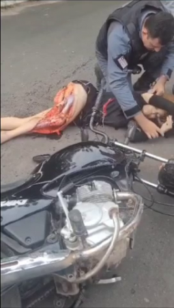 The Meat Of A Woman's Leg Is Torn Off After An Accident