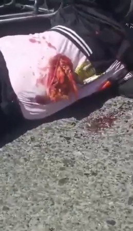 A Man's Stomach Torn Open As A Result Of An Accident