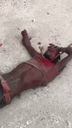 Dude With Severed Hands Is Not Allowed To Die In Peace. Haiti