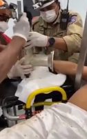 Rescuers Remove A Woman's Hand From A Meat Grinder