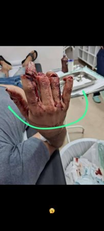 The Dude's Fingers Were Cut Off As Punishment For Stealing. Good Doctors Sewed Them Back