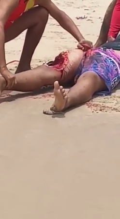 The Result Of A Shark Attack Is Visible On A Woman's Leg