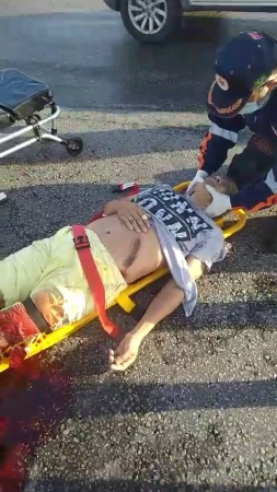 As A Result Of The Accident, The Victim's Leg Was Broken In Several Places