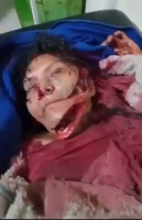 Sick Idiot Attacked His Girlfriend With A Machete Out Of Jealousy. Peru. Aftermath