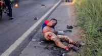 As A Result Of The Accident, The Motorcyclist Received Severe Burns And Both Legs Were Crushed