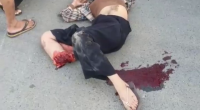 As A Result Of A Traffic Accident, A Young Woman Lost Her Leg