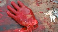 Dude Who Cut Off His Hand Died Due To Blood Loss