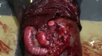 Some Guy Still Alive With His Intestines Out