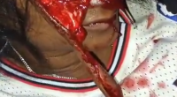 Two Women Seriously Injured In A Traffic Accident